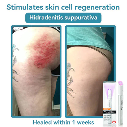 ✨DarkFairy™ All-in-One CO₂ Laser Eraser Pen | Removes Moles, Warts, Skin Flaws & Pigmentation